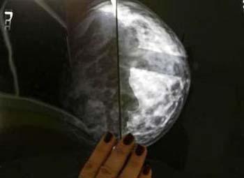 A breast cancer patient is framed through a breast x-ray after a radiological medical examination in an Athens hospital October 29, 2008.[Agencies]