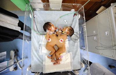 Conjoined twins wait for a thorough examination in the intensive care unit at the Children's Hospital of Hunan Province in Changsha, capital of central-south China's Hunan Province, March 19, 2009. The twins born on March 16 in Xinhua County of the province weigh 4.8 kilograms and are connected by abdomen. Doctors of the Children's Hospital of Hunan Province would give them a thorough examination and find a way to do the separation surgery. (Xinhua