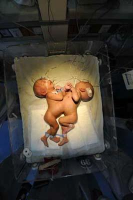 The conjoined twins are seen before the separation surgery at Hunan Children's Hospital in Changsha, capital of central China's Hunan Province, April 1, 2009. A pair of conjoined twin girls were successfully separated on Wednesday after a six-and-half hour operation and in a stable condition. The twins were born joined at the abdomen and shared same umbilical cord in Xinhua County of Loudi City in Hunan Province on March 16, 2009. (Xinhua photo)