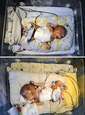 Combo photo shows siamese twins sisters Lanlan (up) and Honghong (down) receiving intensive care at Hunan Children's Hospital in central China's Hunan Province, April 5, 2009. Lanlan and Honghong, twin girls who were born on March 16 with abdomen connected, received separation surgery on April 1. Although they haven't passed the critical stage yet, their health is improving step by step. (Xinhua Photo)