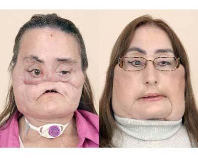 This is a photo of Connie Culp, after an injury to her face(L), and then as she appears today. Culp is underwent the first face transplant surgery the United States at the Cleveland Clinic in December 2008. Culp spoke to the media at a news conference at the Cleveland Clinic in Cleveland, on Tuesday, May 5, 2009. The 46-year-old mother of two lost most of the midsection of her face to a gunshot in 2004.(Xinhua/AFP Photo)