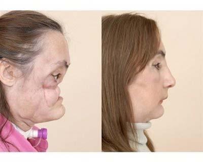 This is a photo of Connie Culp, after an injury to her face(L), and then as she appears today. 